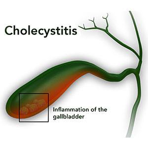 Cholecystitis