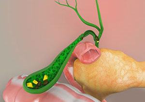 Gallstones