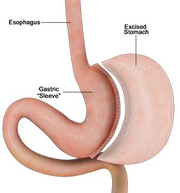 Gastric Sleeve