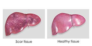 Cirrhosis