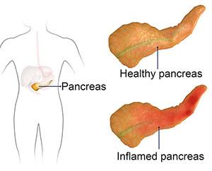 Pancreatitis